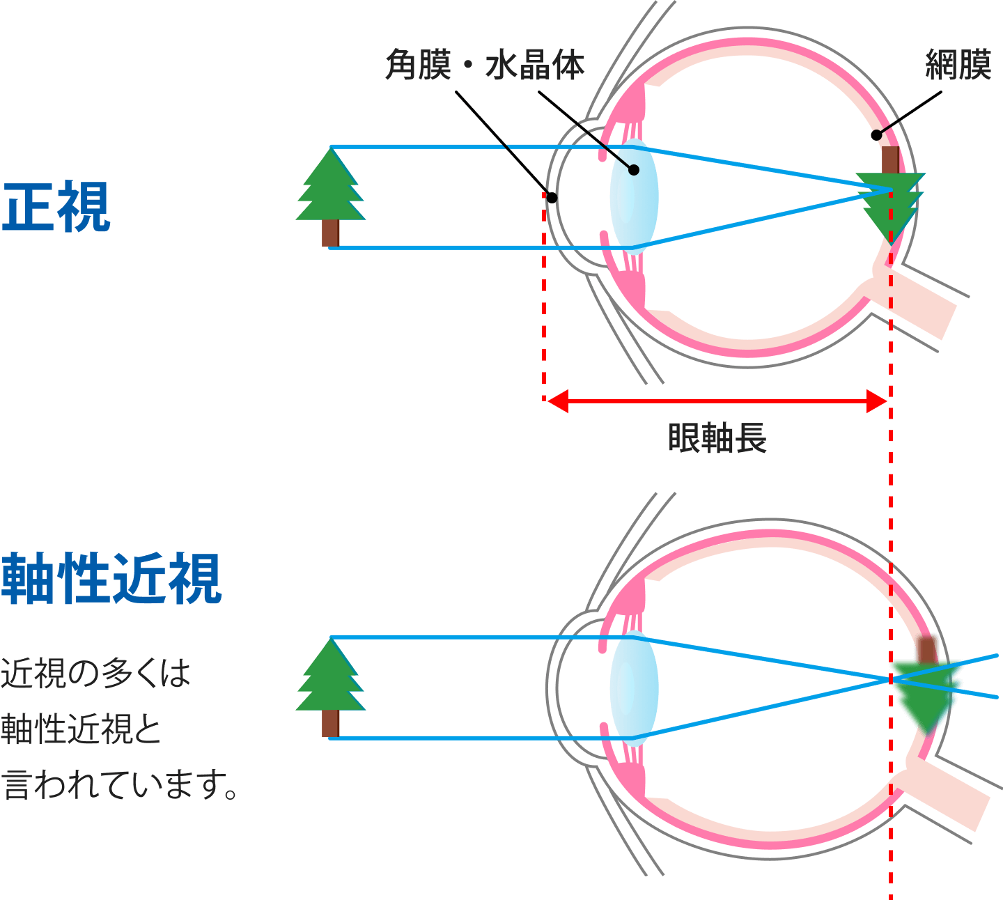 正視, 軸性近視: 近視の多くは軸性近視と言われています。