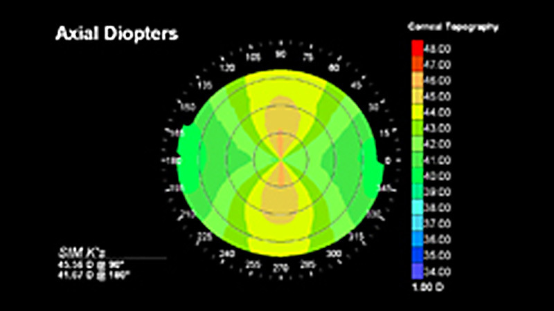 角膜形状解析　カラーマップの例