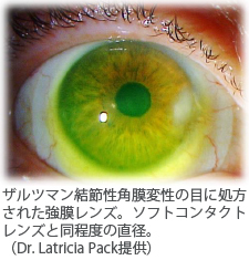 ザルツマン結節性角膜変性の目に処方された強膜レンズ